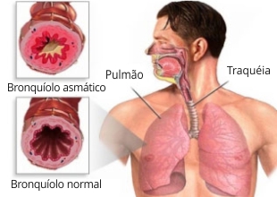Bronquíolo asmático